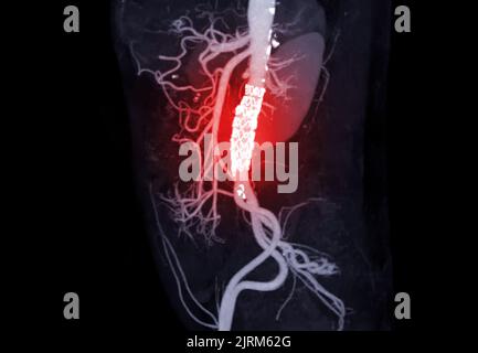 CTA dell'aorta addominale con innesto con stent in aneurisma aortico addominale del paziente. Foto Stock