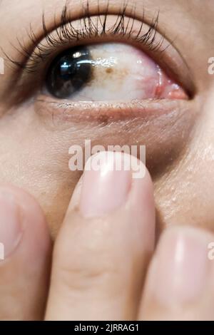 Una donna con Brown Spot sulla sclera diagnosticata come congiuntivite emorragica Foto Stock