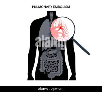L'embolia polmonare, illustrazione Foto Stock