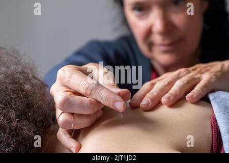 Donna profesionale che dà il trattamento di agopuntura. Foto di alta qualità Foto Stock