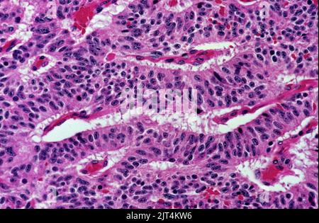Tumore carcinoide tipico del polmone, modello trabecolare. Foto Stock