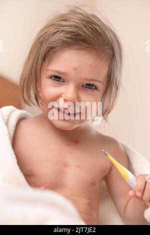 Bambino con varicella seduto con Thermomete Foto Stock