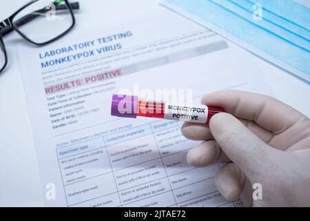 Risultati positivi del test del monkeypox nelle provette per il prelievo ematico Foto Stock