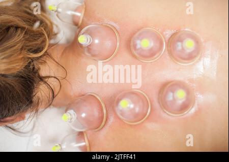 Terapia di cupping sottovuoto di vetro sulla schiena di una donna, trattamento di agopuntura. Massaggio tradizionale Ventosa. Medicina alternativa. Assistenza sanitaria medica Foto Stock