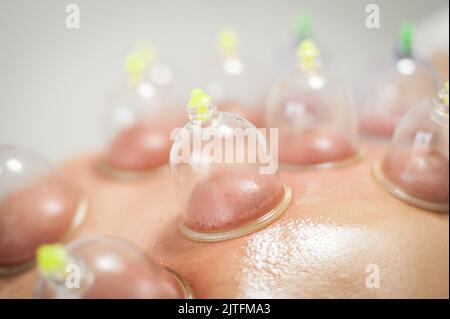 Terapia di cupping sottovuoto di vetro sulla schiena di una donna, trattamento di agopuntura. Massaggio tradizionale Ventosa. Medicina alternativa. Assistenza sanitaria medica Foto Stock