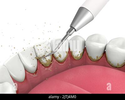 Igiene orale: denti ad ultrasuoni macchina per la pulizia la