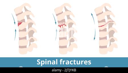 Fratture spinali. I tipi di fratture spinali dipendono dalla direzione del danno. Frattura delle vertebre (dorsale) causata da lesioni, traumi, cadute, sport Illustrazione Vettoriale