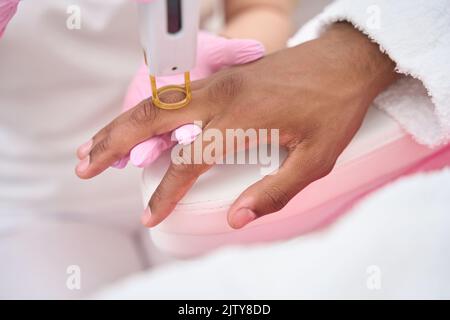 Dermatologo clinica di bellezza che esegue la procedura di rimozione dei capelli sulla mano maschile Foto Stock