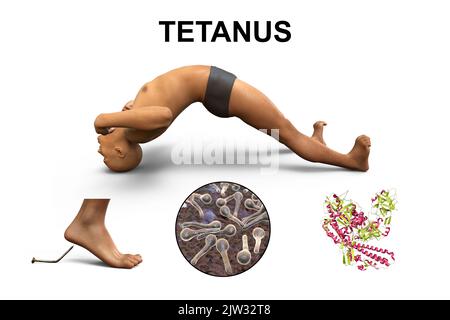 Meccanismo della malattia di tetano, illustrazione. Una ferita della pelle è contaminata con i batteri del Clostridium tetani che producono una neurotossina che raggiunge il midollo spinale e causa la paralisi spastica. L'uomo si trova in opistotono (spasmo all'indietro), uno stato di grave iperestensione e spasticità. Foto Stock