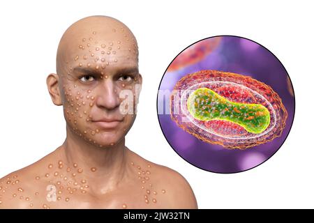 Paziente con vaiolo (variola) e primo piano di un virus del vaiolo, illustrazione. Il vaiolo è una malattia che causa febbre e spesso la morte. È stato sradicato dopo uno sforzo mondiale negli anni '1970s, ma esistono ceppi nei laboratori di ricerca. Lesioni cutanee simili si possono trovare nei virus attualmente disponibili della famiglia Poxviridae, come il monkeypox, che hanno anche la stessa morfologia del virione. Foto Stock