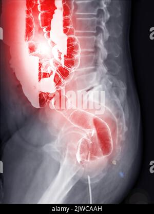 L'enema di bario o BE è l'immagine dell'intestino crasso dopo l'iniezione del riempimento di contrasto di bario nel colon sotto controllo fluoroscopico isolato su sfondo bianco Foto Stock