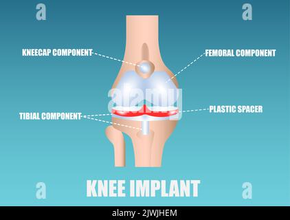Vettore di un impianto di ginocchio umano Illustrazione Vettoriale