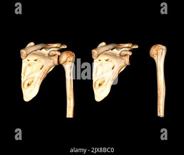 Tomografia computerizzata Volume rendering esame del rendering spalla 3D in frattura dell'articolazione della spalla del paziente. Foto Stock