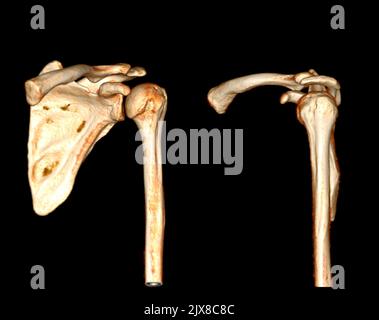 Tomografia computerizzata Volume rendering esame del rendering spalla 3D in frattura dell'articolazione della spalla del paziente. Foto Stock