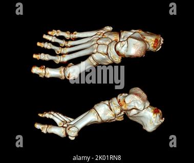 Tomografia computerizzata del piede ,3D Volume rendering esame del piede ( CT VR foot) . Rendering 3D. Foto Stock