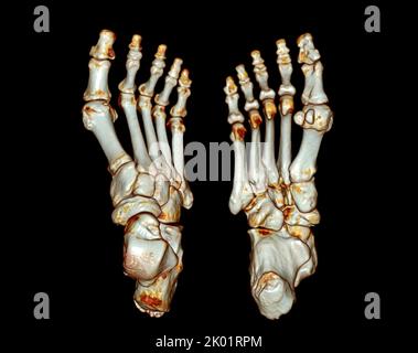 Tomografia computerizzata del piede ,3D Volume rendering esame del piede ( CT VR foot) . Rendering 3D. Foto Stock