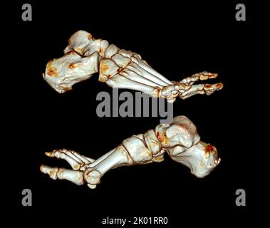 Tomografia computerizzata del piede ,3D Volume rendering esame del piede ( CT VR foot) . Rendering 3D. Foto Stock