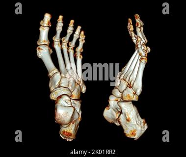 Tomografia computerizzata del piede ,3D Volume rendering esame del piede ( CT VR foot) . Rendering 3D. Foto Stock