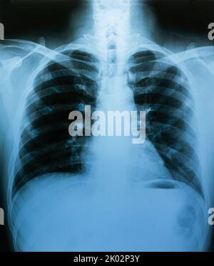 Pellicola per raggi X, struttura polmonare e ossea, esame sanitario Foto Stock