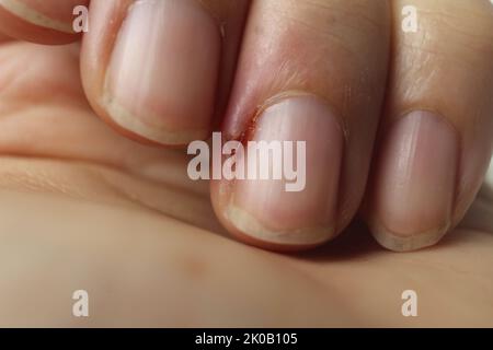 piastra del chiodo del dito danneggiata con infiammazione della ferita in primo piano. Cura delle mani malattie delle unghie malattie delle unghie. Foto Stock