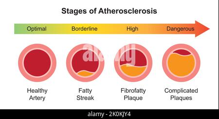 Progettazione scientifica di stadi di aterosclerosi. L'accumulo di grassi e colesterolo in Artery Walls. Simboli colorati. Illustrazione vettoriale. Illustrazione Vettoriale