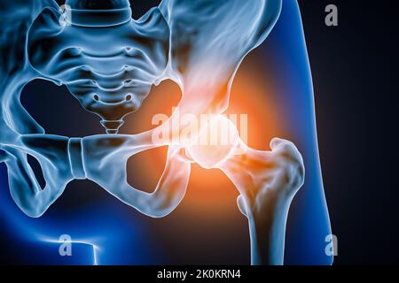 Vista anteriore o anteriore dell'articolazione dell'anca e delle ossa umane con infiammazione o lesione 3D illustrazione della rappresentazione. Patologia, dolore articolare, anatomia, osteolo Foto Stock