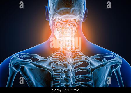 Vista posteriore o posteriore della colonna vertebrale o della colonna vertebrale umana con infiammazione o lesione 3D illustrazione del rendering. Patologia, dolore alla spina dorsale, anatomia, cervi Foto Stock