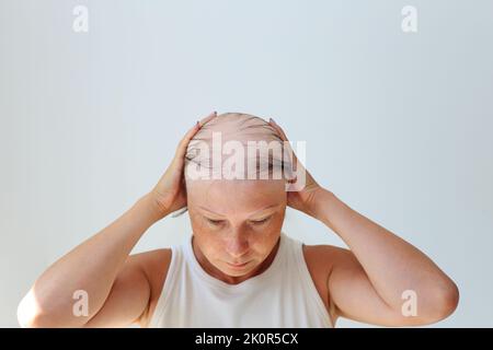 Perdita di capelli sotto forma di alopecia areata. Testa calva di una donna. Diradamento dei capelli dopo il covid. Cerotti calvo di alopecia totale Foto Stock