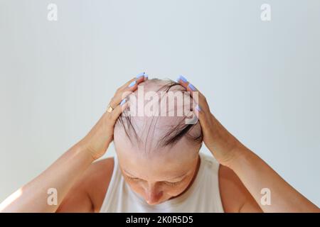 Perdita di capelli sotto forma di alopecia areata. Testa calva di una donna. Diradamento dei capelli dopo il covid. Cerotti calvo di alopecia totale Foto Stock
