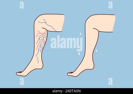 Primo piano della gamba sana e malsana con vene varicose. Il paziente soffre di varicosi. Sanità e medicina. Illustrazione vettoriale. Illustrazione Vettoriale