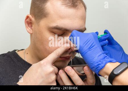 Un infermiere risciacqua la cavità nasale di un paziente affetto da sinusite con soluzione salina utilizzando una siringa. Foto Stock