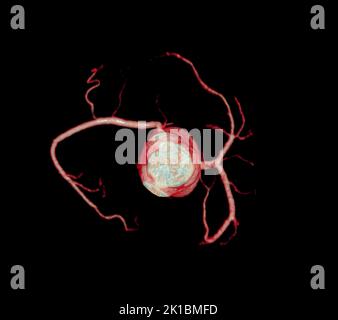 CT Cardiac 3D o CTA coronary Artery per la prevenzione delle malattie coronariche. Foto Stock