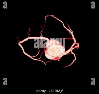 CT Cardiac 3D o CTA coronary Artery per la prevenzione delle malattie coronariche. Foto Stock