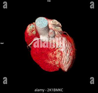 CT Cardiac 3D o CTA coronary Artery per la prevenzione delle malattie coronariche. Foto Stock