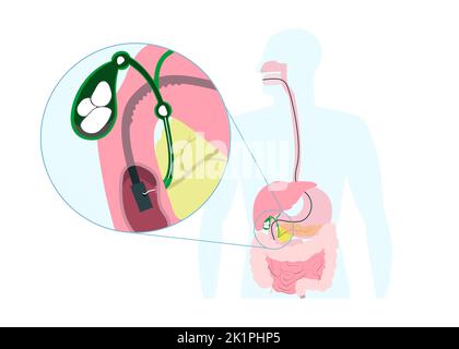 Rimozione endoscopica della pietra della cistifellea attraverso la bocca, lo stomaco, al dotto biliare. Infografiche delle operazioni mediche. Illustrazione Vettoriale