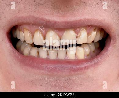 Bocca sorridente dell'uomo con denti gialli storti da vicino. Denti usurati malsani che richiedono un trattamento in odontoiatria. Bruxismo Foto Stock