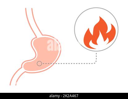 Concetto di malattia da reflusso acido. Stomaco umano al fuoco, vista tagliata. Illustrazione vettoriale in stile piatto Foto Stock