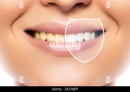 Sbiancamento dei denti e igiene. Risultato dopo il trattamento in clinica odontoiatrica professionale. Foto Stock