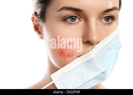 Maskne - i breakouts dell'acne da portare una maschera di faccia Foto Stock