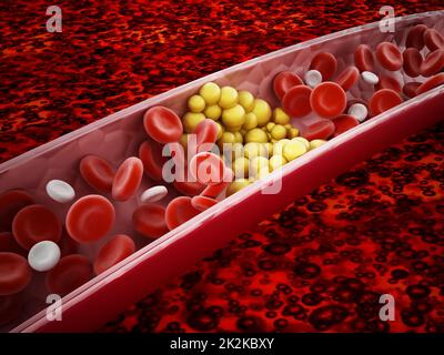 Le cellule grasse che bloccano il flusso sanguigno all'interno della vena umana. Illustrazione 3D Foto Stock