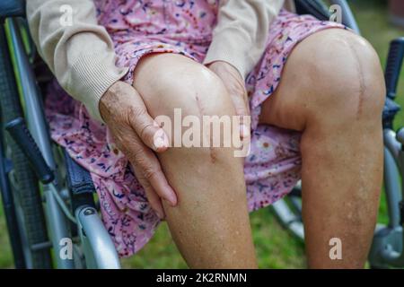 Paziente asiatico anziano con chirurgia sostitutiva del ginocchio cicatrice in ospedale. Foto Stock