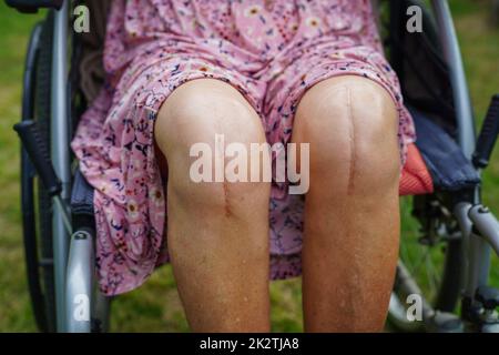 Paziente asiatico anziano con chirurgia sostitutiva del ginocchio cicatrice in ospedale. Foto Stock