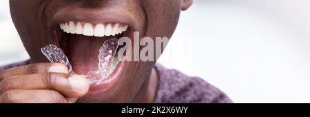 Uomo regolare gli allineatori trasparenti nei suoi denti Foto Stock