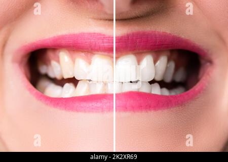 Denti della donna prima e dopo lo sbiancamento Foto Stock