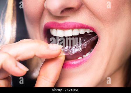 Donna mettendo allineatore trasparente in denti Foto Stock