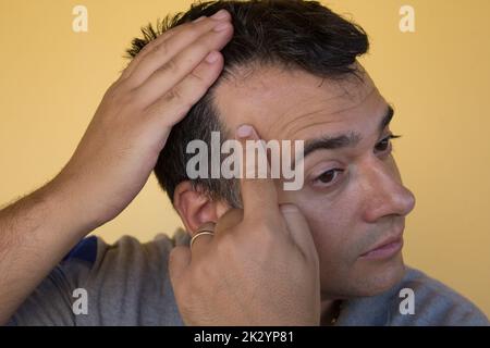 Immagine di un uomo che mostra l'inizio della perdita di capelli e il principio di receding hairline. Possibili cause e rimedi per la perdita dei capelli Foto Stock