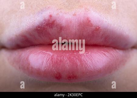 Segni di lividi dopo iniezioni di collagene o riempitivi su Donna labbra primo piano. Vista dopo labbro procedura di aumento medico con riempitivi, Foto Stock