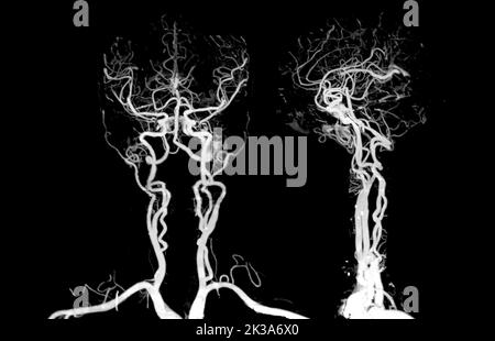 CTA cervello o angiografia TC del cervello 3D immagine di rappresentazione per diagnosi aneurisma dell'arteria cerebrale. Foto Stock