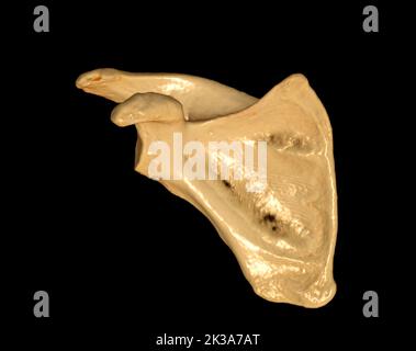 CT Shoulder 3D dell'esame di rappresentazione volumetrica della tomografia computerizzata del rendering della spalla 3D in caso di frattura dell'articolazione della spalla. Foto Stock