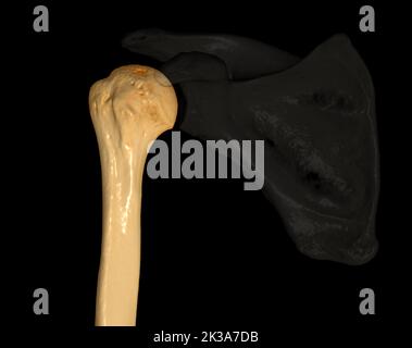 CT Shoulder 3D dell'esame di rappresentazione volumetrica della tomografia computerizzata del rendering della spalla 3D in caso di frattura dell'articolazione della spalla. Foto Stock